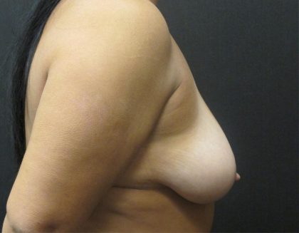 Breast Lift Before & After Patient #1237