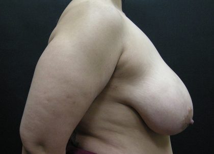 Breast Reduction Before & After Patient #1444