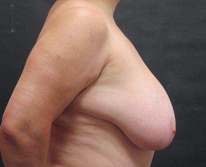 Breast Reduction Before & After Patient #1416