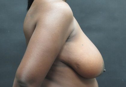 Breast Reduction Before & After Patient #1341