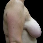Breast Reduction Before & After Patient #1447