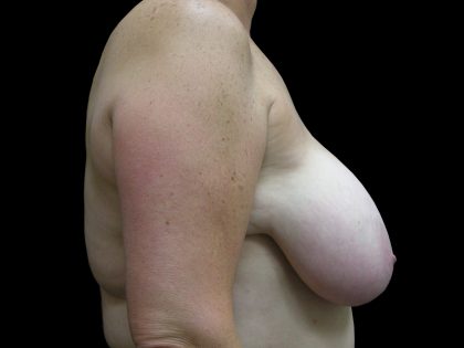 Breast Reduction Before & After Patient #1447