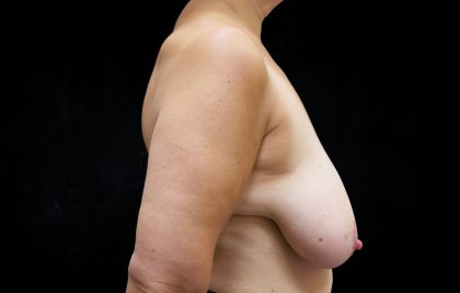 Breast Reduction Before & After Patient #1354
