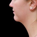 Scarless Facelift and Necklift Before & After Patient #3056