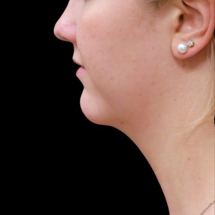 Scarless Facelift and Necklift Before & After Patient #3056