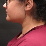 Scarless Facelift and Necklift Before & After Patient #3108