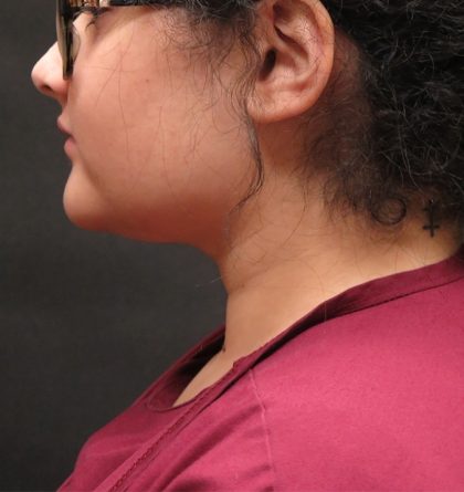 Scarless Facelift and Necklift Before & After Patient #3108