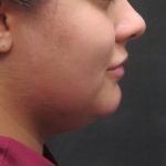 Scarless Facelift and Necklift Before & After Patient #3028