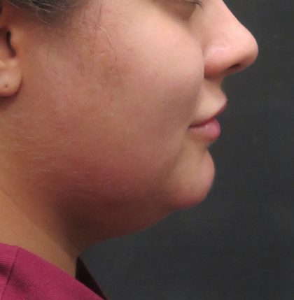 Scarless Facelift and Necklift Before & After Patient #3028