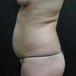 Mommy Makeover Before & After Patient #2657