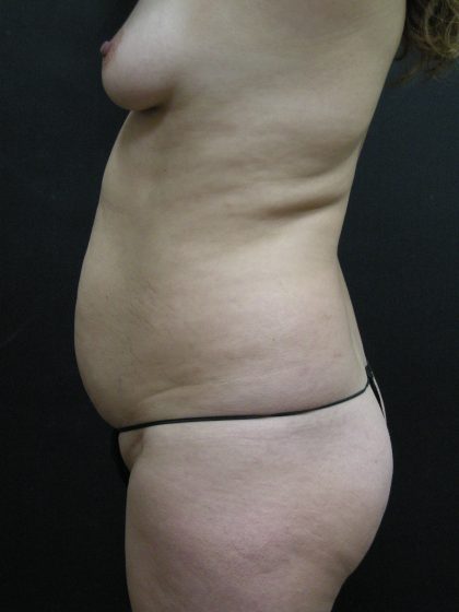 Mommy Makeover Before & After Patient #2657