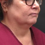 Scarless Facelift and Necklift Before & After Patient #3049