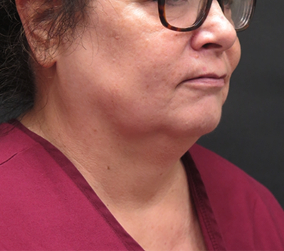 Scarless Facelift and Necklift Before & After Patient #3049