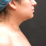 Scarless Facelift and Necklift Before & After Patient #3067