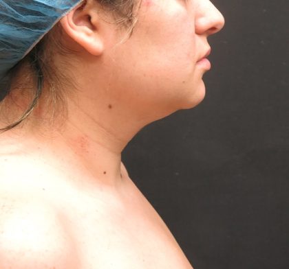 Scarless Facelift and Necklift Before & After Patient #3067