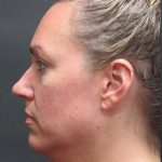 Scarless Facelift and Necklift Before & After Patient #3101