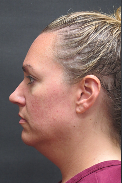 Scarless Facelift and Necklift Before & After Patient #3101