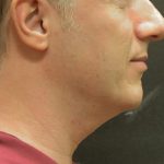 Scarless Facelift and Necklift Before & After Patient #3074
