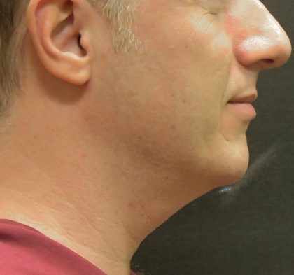 Scarless Facelift and Necklift Before & After Patient #3074