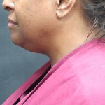 Scarless Facelift and Necklift Before & After Patient #1910
