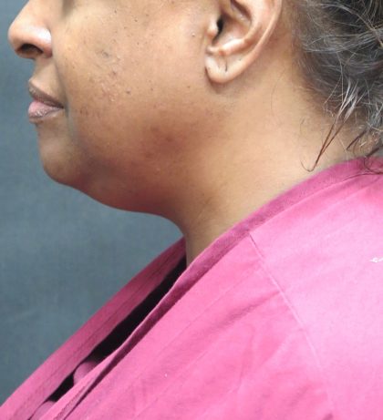 Scarless Facelift and Necklift Before & After Patient #1910