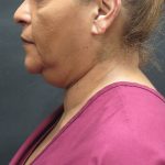 Scarless Facelift and Necklift Before & After Patient #3081