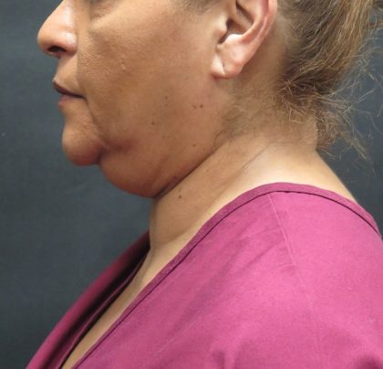 Scarless Facelift and Necklift Before & After Patient #3081