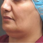 Scarless Facelift and Necklift Before & After Patient #3094