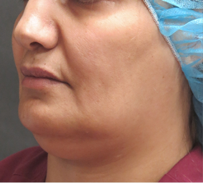 Scarless Facelift and Necklift Before & After Patient #3094