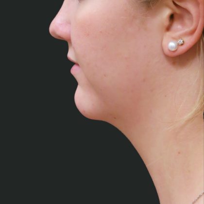Fat Transfer Before & After Patient #1782