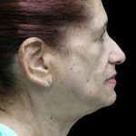 Fat Transfer Before & After Patient #1765