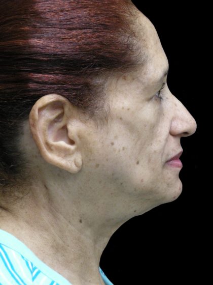 Fat Transfer Before & After Patient #1765