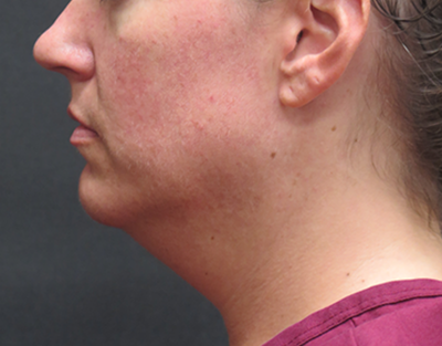 Fat Transfer Before & After Patient #1789