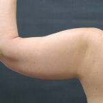 Arm Lift Before & After Patient #888