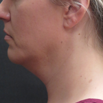 Fat Transfer Before & After Patient #1789