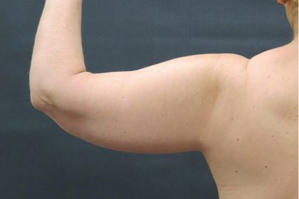 Arm Lift Before & After Patient #888