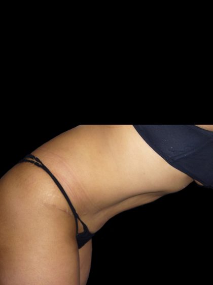 Tummy Tuck Before & After Patient #3155