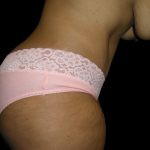 Tummy Tuck Before & After Patient #3166
