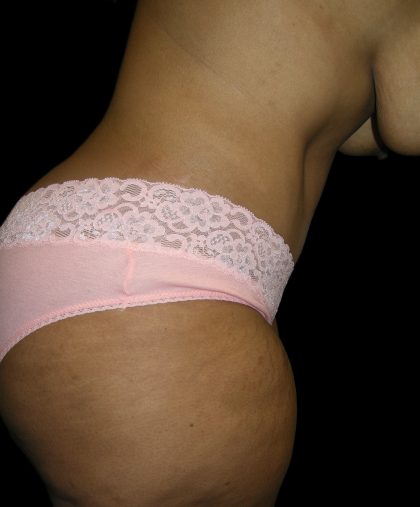 Tummy Tuck Before & After Patient #3166