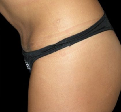 Tummy Tuck Before & After Patient #3175