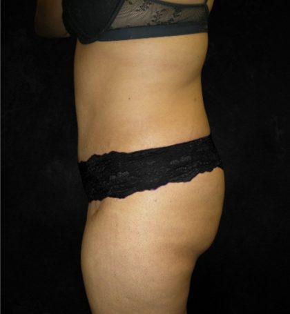 Tummy Tuck Before & After Patient #3186