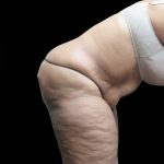 Tummy Tuck Before & After Patient #3209