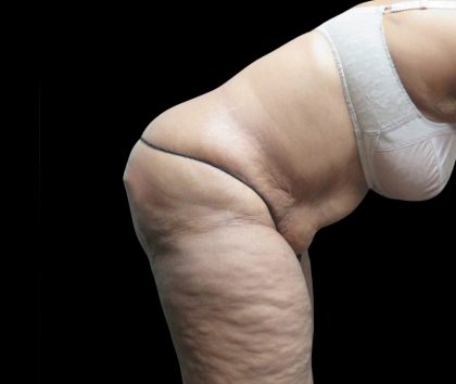Tummy Tuck Before & After Patient #3209