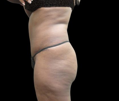 Tummy Tuck Before & After Patient #3216
