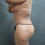 Tummy Tuck Before & After Patient #3225
