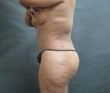 Tummy Tuck Before & After Patient #3225