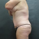 Tummy Tuck Before & After Patient #3245