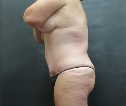 Tummy Tuck Before & After Patient #3245