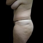 Tummy Tuck Before & After Patient #3286