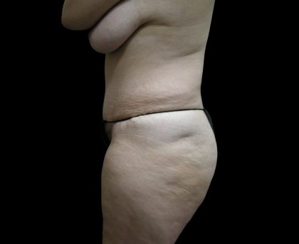 Tummy Tuck Before & After Patient #3286